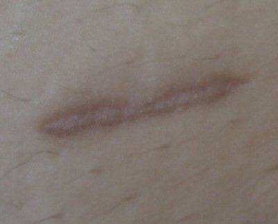 healed - healed -