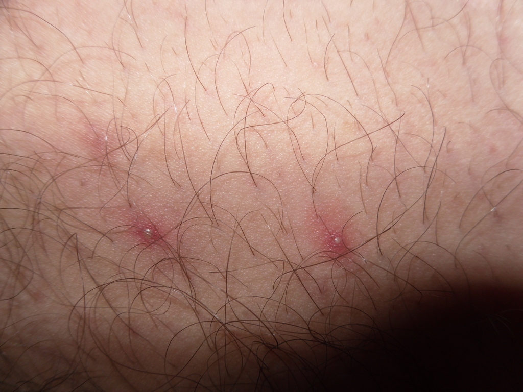 Is It Possible That This Is Not Herpes Herpes Medhelp